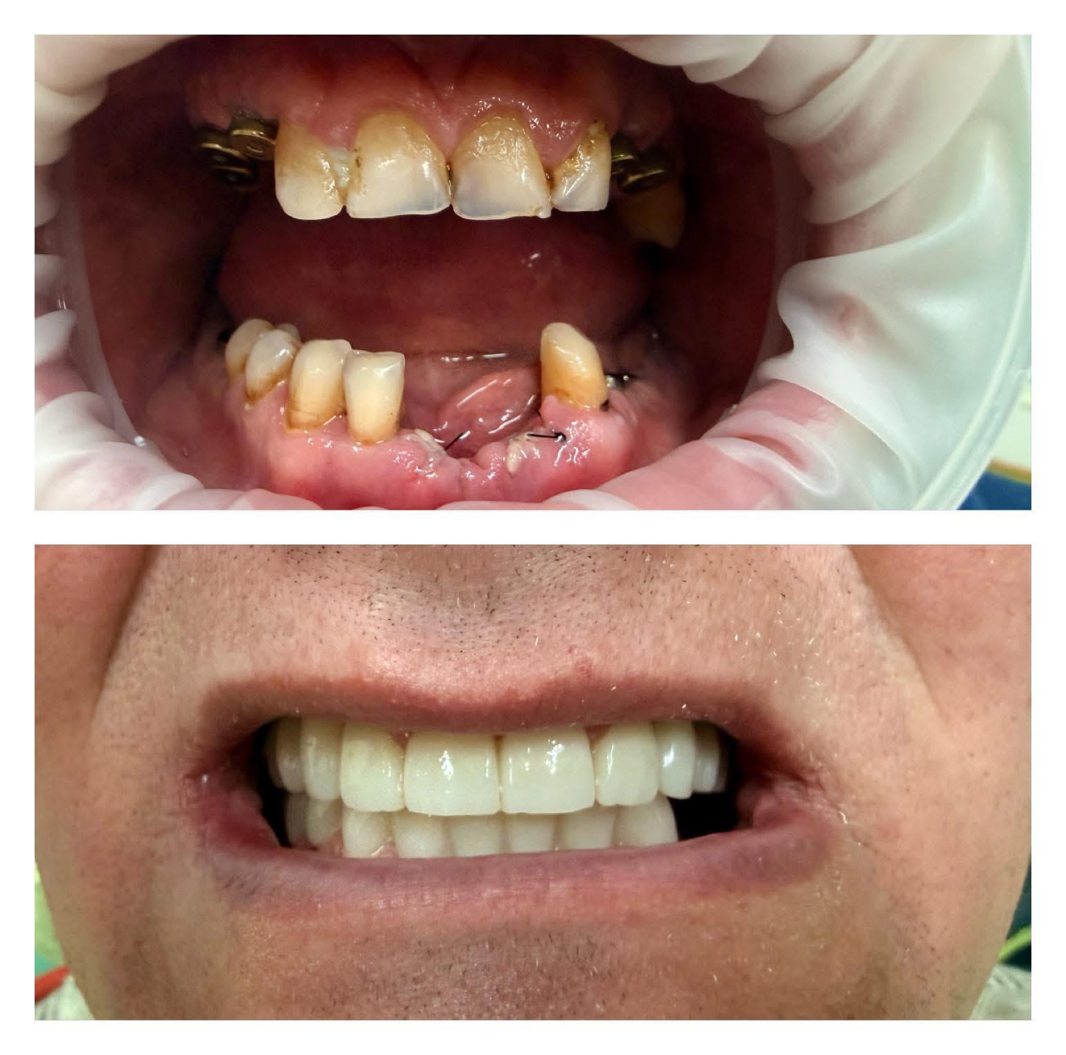 Studiu de caz implantologie dentară