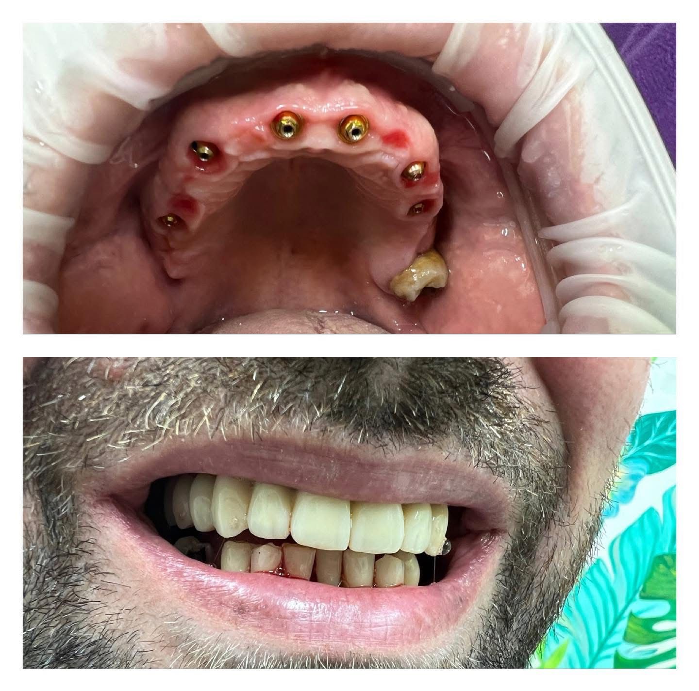 Studiu de caz All-on-4 / All-on-6