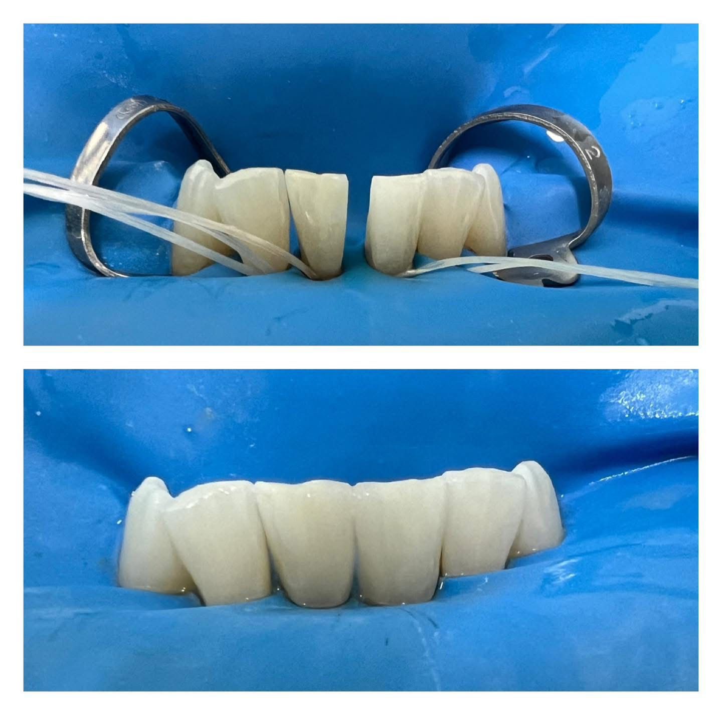 Studiu de caz închidere diastemă